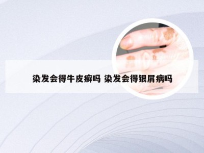 染发会得牛皮癣吗 染发会得银屑病吗