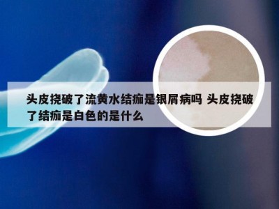 头皮挠破了流黄水结痂是银屑病吗 头皮挠破了结痂是白色的是什么