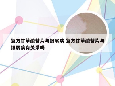 复方甘草酸苷片与银屑病 复方甘草酸苷片与银屑病有关系吗