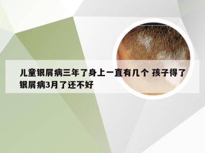 儿童银屑病三年了身上一直有几个 孩子得了银屑病3月了还不好