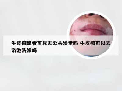牛皮癣患者可以去公共澡堂吗 牛皮癣可以去浴池洗澡吗