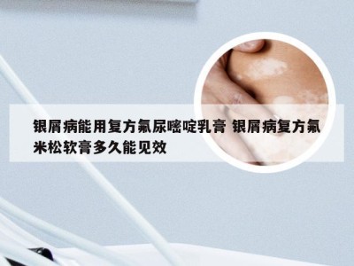 银屑病能用复方氟尿嘧啶乳膏 银屑病复方氟米松软膏多久能见效