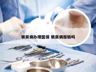 银屑病办理医保 银屑病报销吗