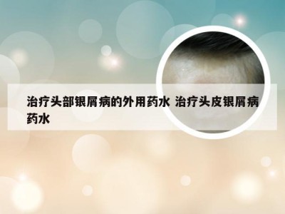 治疗头部银屑病的外用药水 治疗头皮银屑病药水
