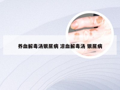 养血解毒汤银屑病 凉血解毒汤 银屑病