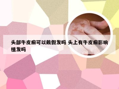 头部牛皮癣可以戴假发吗 头上有牛皮癣影响植发吗