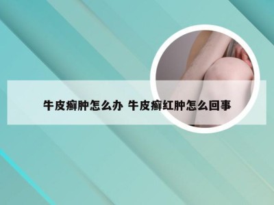 牛皮癣肿怎么办 牛皮癣红肿怎么回事