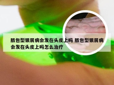 脓包型银屑病会发在头皮上吗 脓包型银屑病会发在头皮上吗怎么治疗