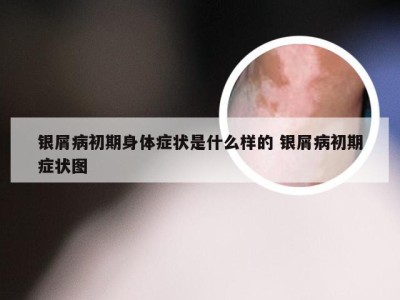 银屑病初期身体症状是什么样的 银屑病初期症状图