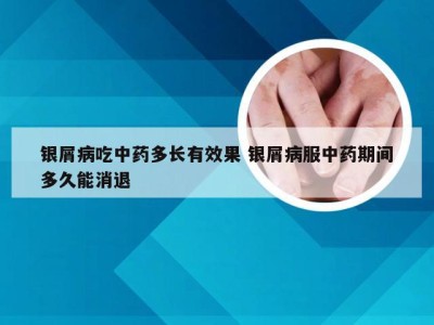 银屑病吃中药多长有效果 银屑病服中药期间多久能消退
