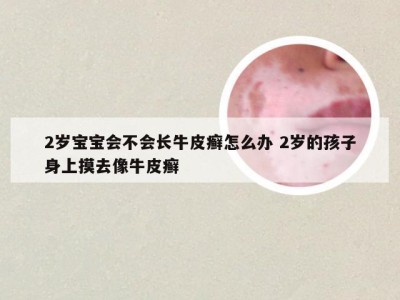 2岁宝宝会不会长牛皮癣怎么办 2岁的孩子身上摸去像牛皮癣