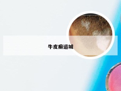 牛皮癣运城