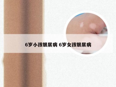 6岁小孩银屑病 6岁女孩银屑病