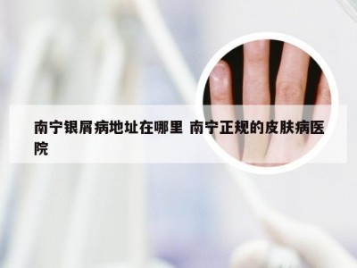 南宁银屑病地址在哪里 南宁正规的皮肤病医院
