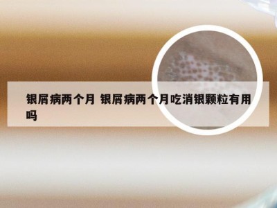 银屑病两个月 银屑病两个月吃消银颗粒有用吗