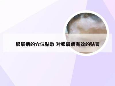 银屑病的穴位贴敷 对银屑病有效的贴膏