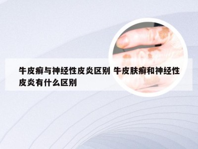 牛皮癣与神经性皮炎区别 牛皮肤癣和神经性皮炎有什么区别