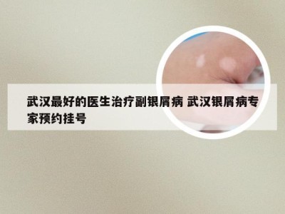 武汉最好的医生治疗副银屑病 武汉银屑病专家预约挂号