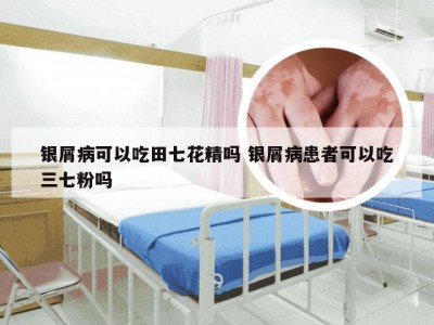 银屑病可以吃田七花精吗 银屑病患者可以吃三七粉吗