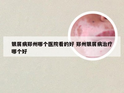 银屑病郑州哪个医院看的好 郑州银屑病治疗哪个好