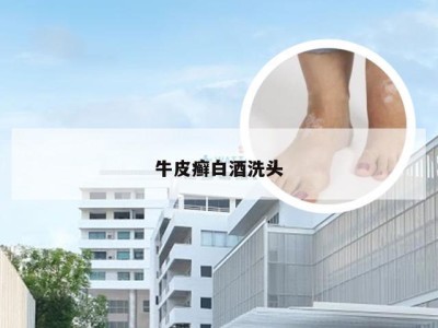 牛皮癣白酒洗头