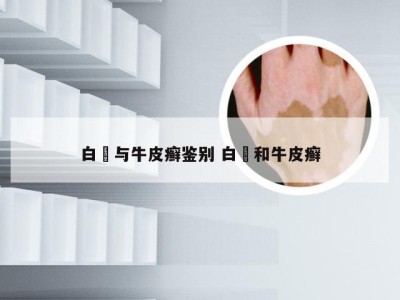 白疕与牛皮癣鉴别 白疕和牛皮癣