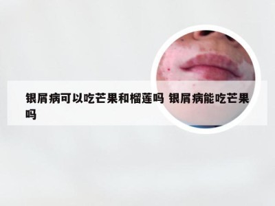 银屑病可以吃芒果和榴莲吗 银屑病能吃芒果吗