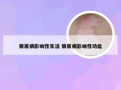 银屑病影响性生活 银屑病影响性功能
