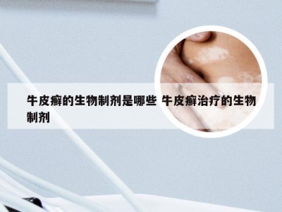 牛皮癣的生物制剂是哪些 牛皮癣治疗的生物制剂