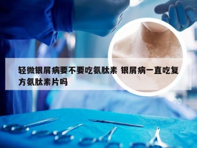 轻微银屑病要不要吃氨肽素 银屑病一直吃复方氨肽素片吗