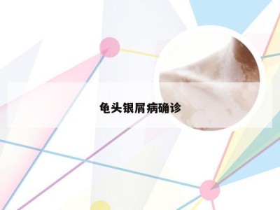 龟头银屑病确诊