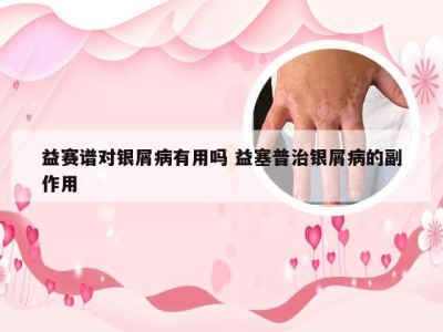 益赛谱对银屑病有用吗 益塞普治银屑病的副作用