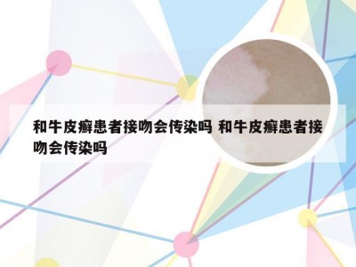 和牛皮癣患者接吻会传染吗 和牛皮癣患者接吻会传染吗