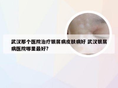 武汉那个医院治疗银屑病皮肤病好 武汉银屑病医院哪里最好?