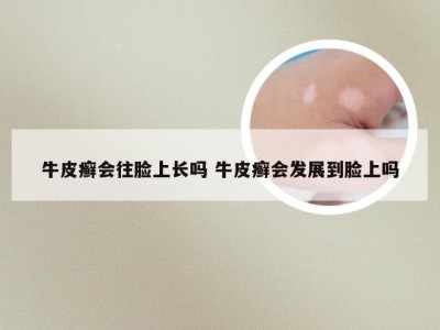 牛皮癣会往脸上长吗 牛皮癣会发展到脸上吗