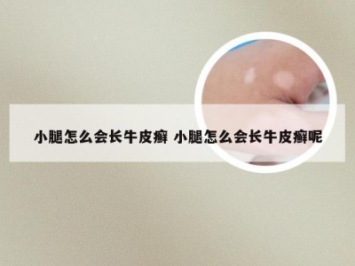 小腿怎么会长牛皮癣 小腿怎么会长牛皮癣呢