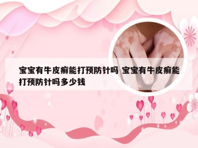 宝宝有牛皮癣能打预防针吗 宝宝有牛皮癣能打预防针吗多少钱