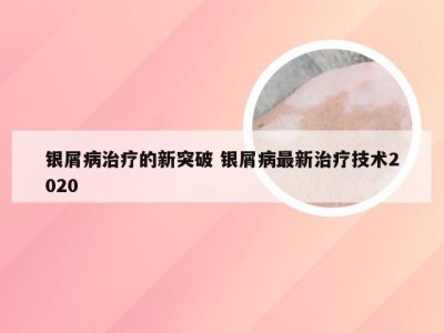 银屑病治疗的新突破 银屑病最新治疗技术2020