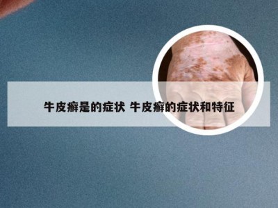 牛皮癣是的症状 牛皮癣的症状和特征