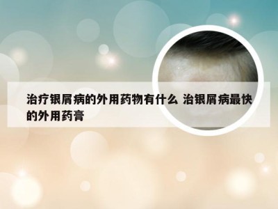 治疗银屑病的外用药物有什么 治银屑病最快的外用药膏