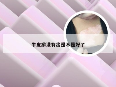 牛皮癣没有出是不是好了