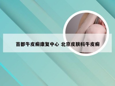 首都牛皮癣康复中心 北京皮肤科牛皮癣