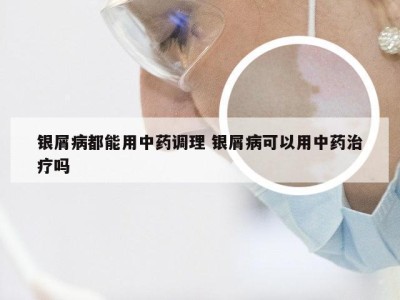 银屑病都能用中药调理 银屑病可以用中药治疗吗