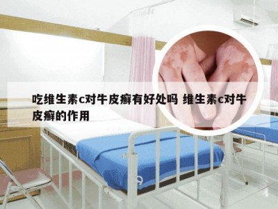 吃维生素c对牛皮癣有好处吗 维生素c对牛皮癣的作用