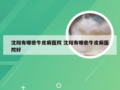 沈阳有哪些牛皮癣医院 沈阳有哪些牛皮癣医院好