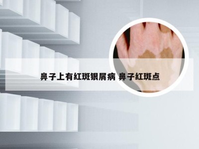 鼻子上有红斑银屑病 鼻子红斑点