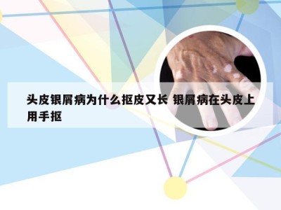 头皮银屑病为什么抠皮又长 银屑病在头皮上用手抠