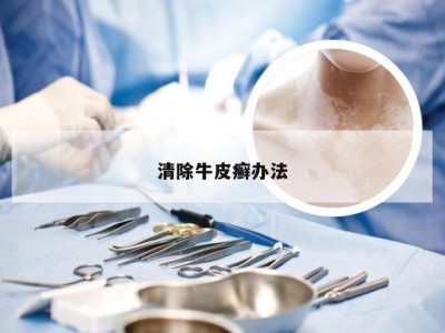 清除牛皮癣办法