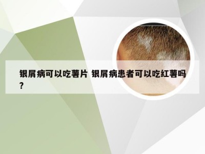 银屑病可以吃薯片 银屑病患者可以吃红薯吗?