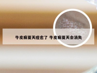 牛皮癣夏天痊愈了 牛皮癣夏天会消失